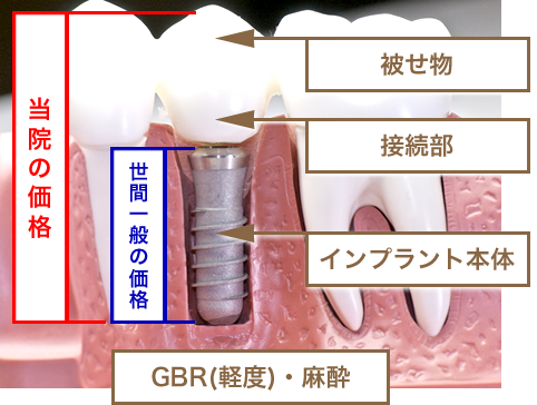 立川アローズ歯科クリニックのインプラント